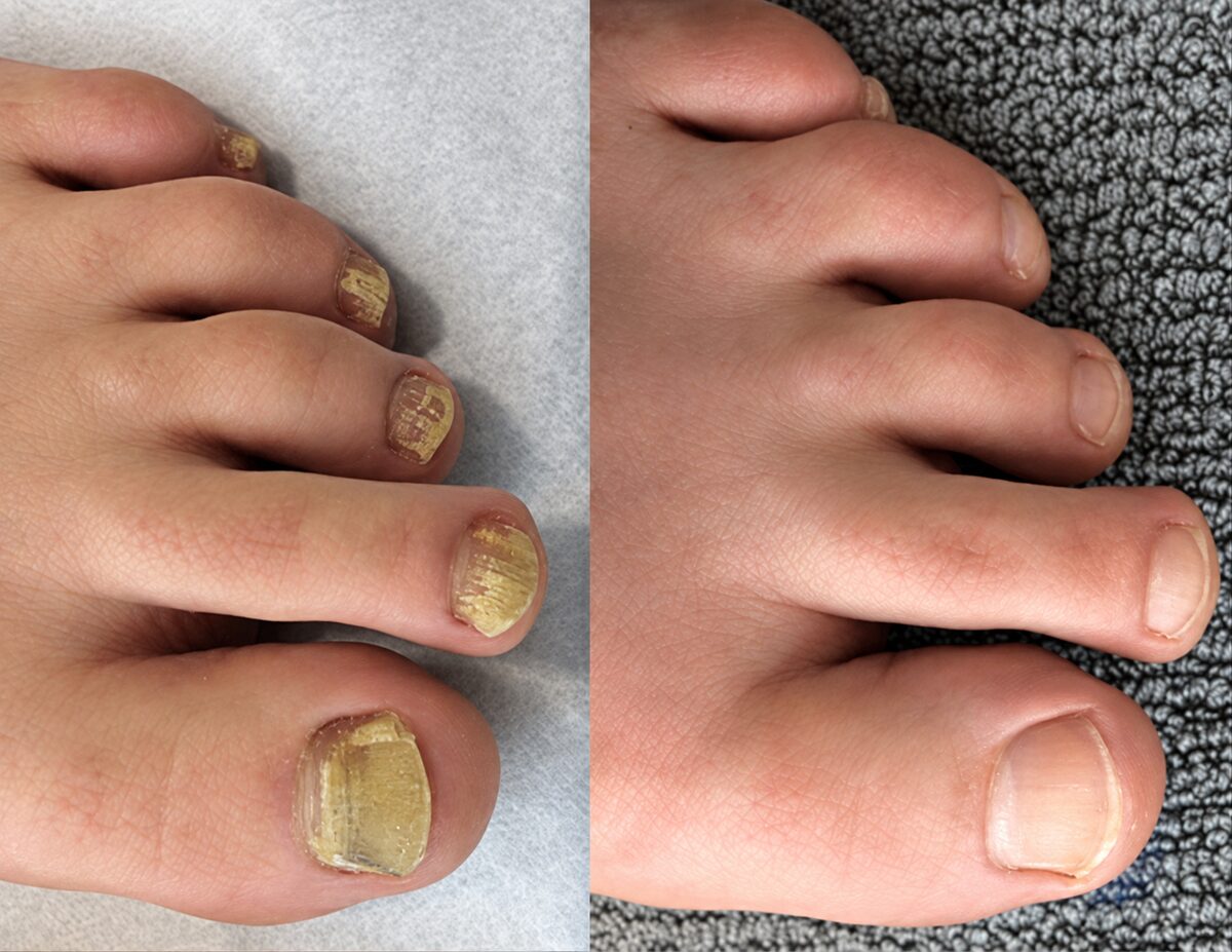 Several discoloured toenails before FungaBeam and clearer new nail growth after