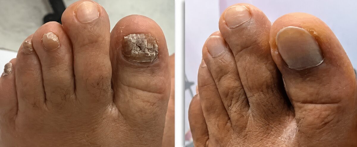 White crumbling toenail surface before FungaBeam and an even nail surface after several weeks