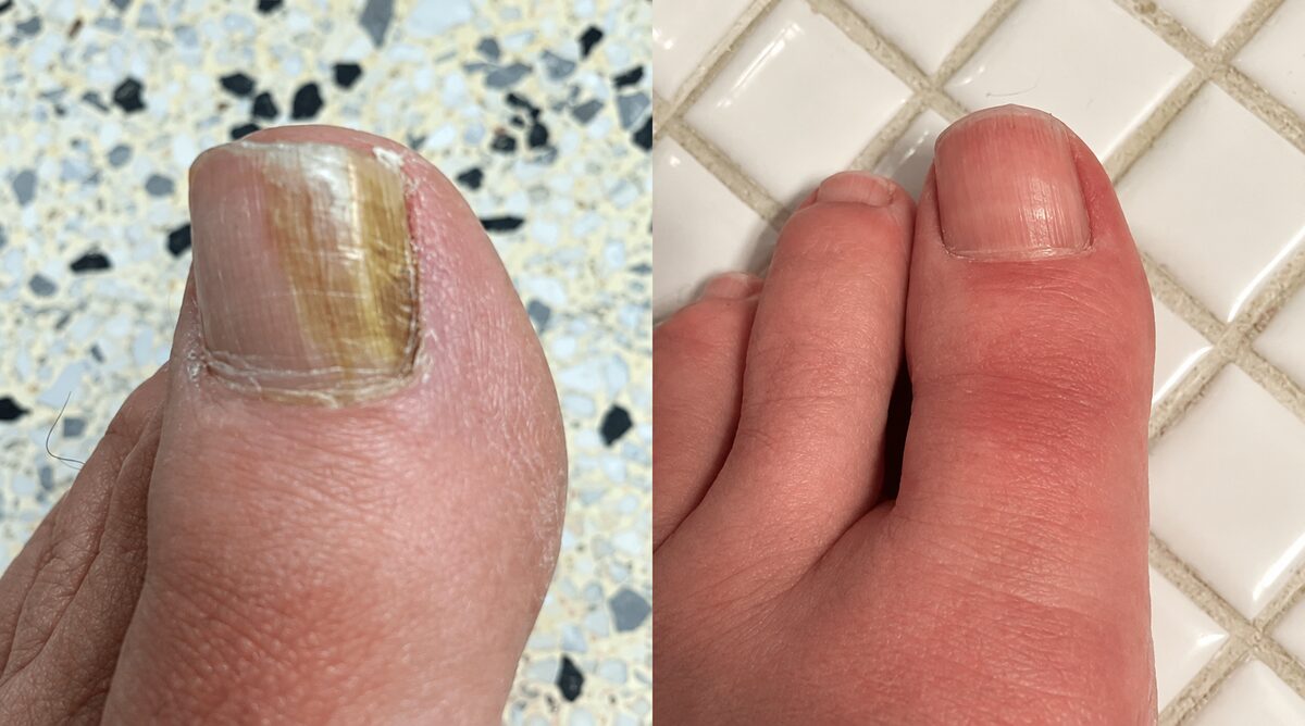 Thick yellowed toenail before FungaBeam and a healthier, thinner nail after consistent use